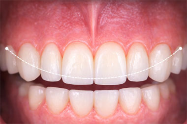 牙冠比例與微笑線