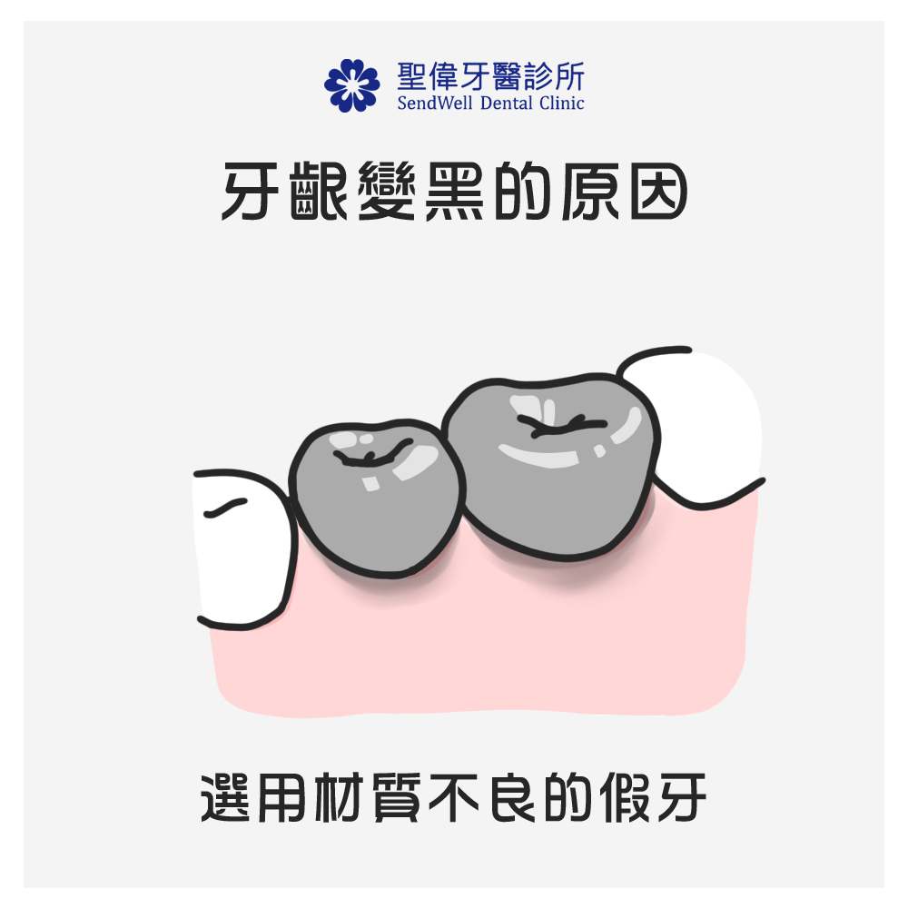 牙齦變黑的原因：選用材質不良的假牙