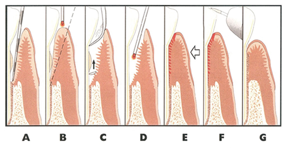 雷射牙周滅菌治療文獻示意圖1