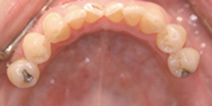 遠端缺牙Free End