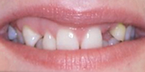 美學活動假牙(缺牙)