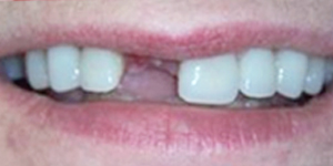 植牙的臨時假牙